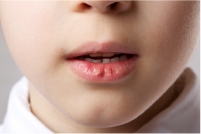 出っ歯がひどい場合の影響 お口の乾燥化
