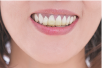 出っ歯がひどい場合の影響 前歯の特徴的な着色汚れ