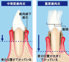 中等度から重度歯周炎イメージ