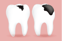 歯の色素沈着の原因 虫歯