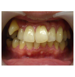 八重歯の場合
