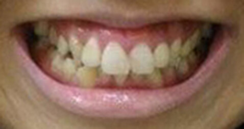歯の生えている位置が低い、歯が短い