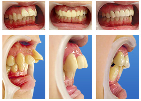歯槽骨整形法症例写真