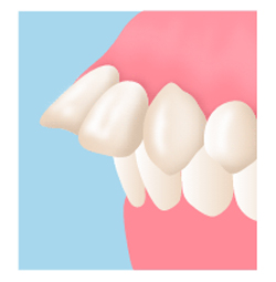 歯科整形の矯正方法とは