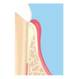 歯茎の再生について