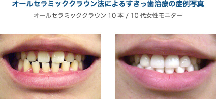 オールセラミッククラウン法によるすきっ歯治療の症例写真