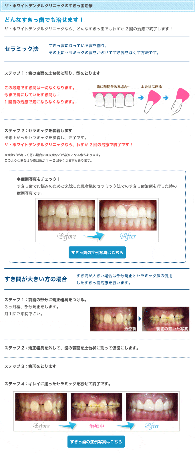 ザ・ホワイトデンタルクリニックのすきっ歯治療