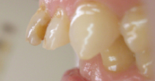上の前歯が下の前歯より出ている（2ミリ程度）