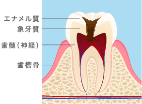 抜髄イメージ