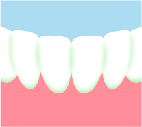 前歯でなりやすい部分のイメージ