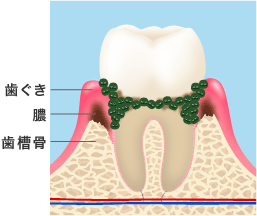 歯についた歯周病菌と膿のイメージ
