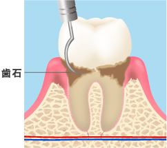 歯石除去のイメージ