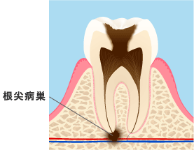 根尖病巣のイメージ