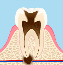 根尖病巣を放置したイメージ