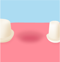 失った歯と隣の歯の土台のイメージ