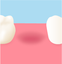 失った歯のイメージ