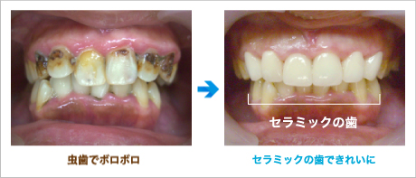 セラミックの歯できれいに