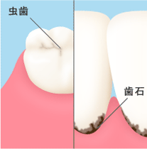 歯石のついた歯のイメージ