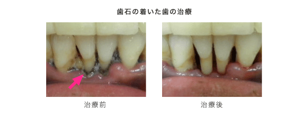 歯石のついた歯の治療