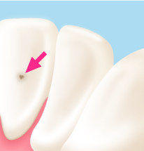 前歯の裏などに黒い点がある歯のイメージ