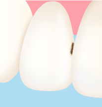 黒い穴がある歯のイメージ