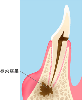 根の先に病巣があって炎症が起きて歯茎が腫れているイラスト