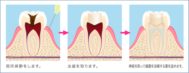 C3治療工程1日目