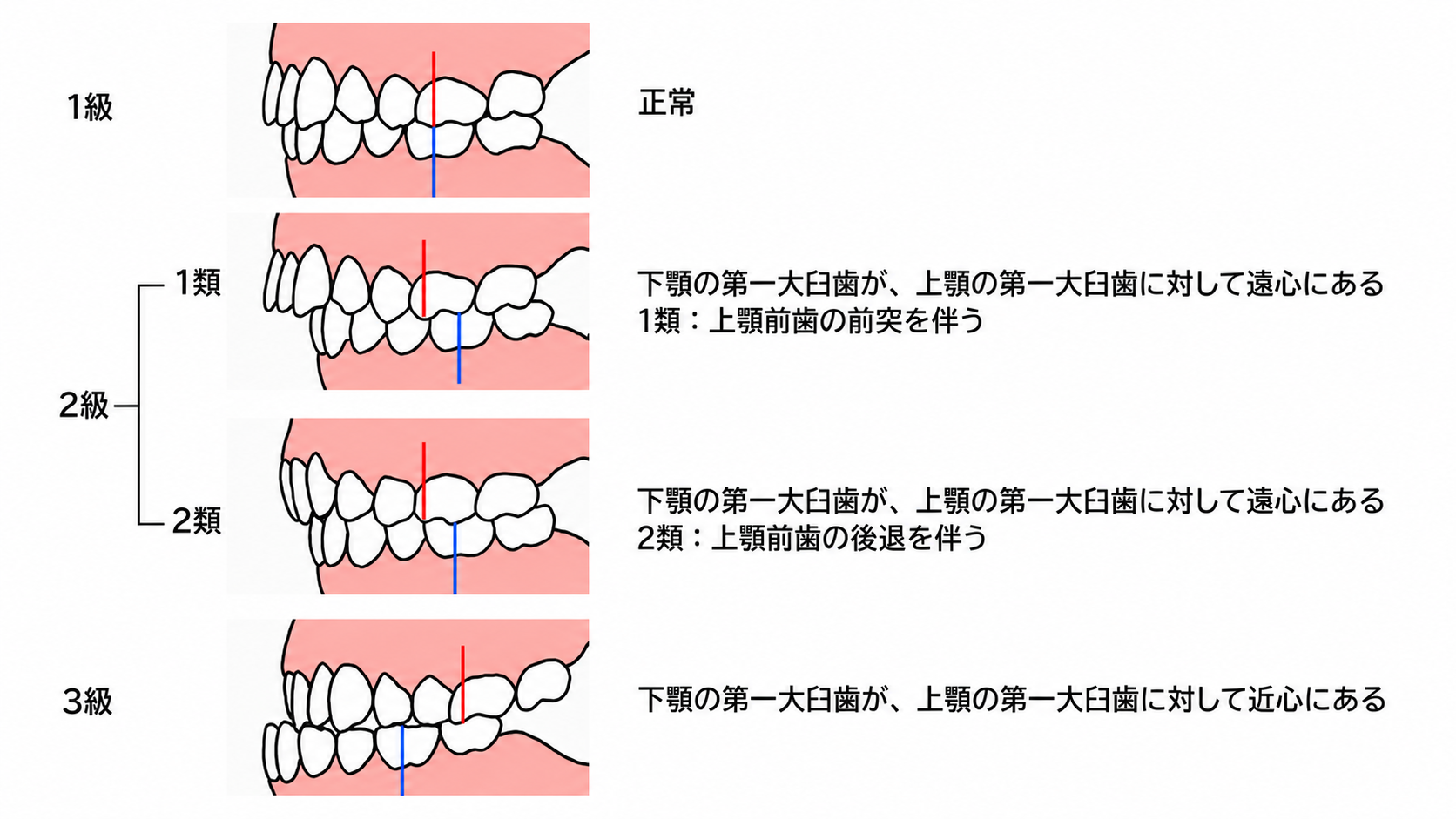矯正の画像