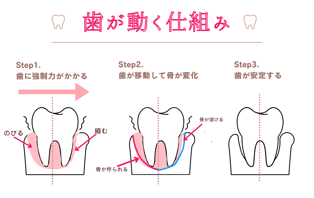 マウスピース矯正は痛みの少ない歯並び治療