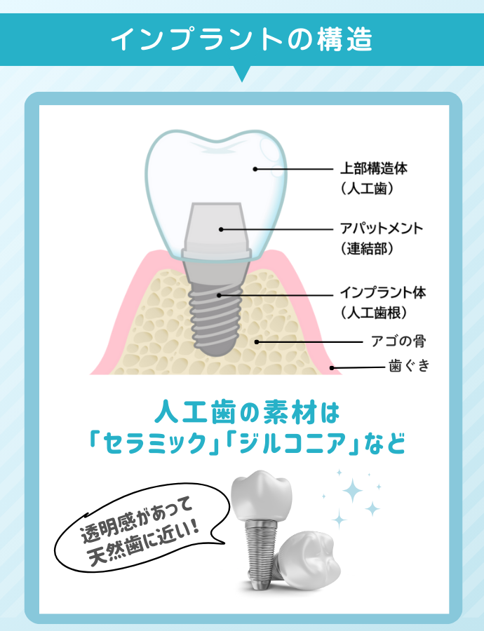 インプラントの構造