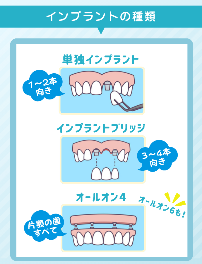 インプラントの種類