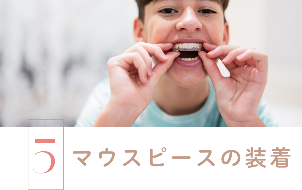 STEP5.マウスピースの装着