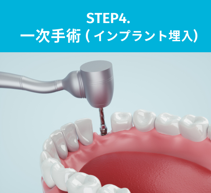 STEP4:一次手術（インプラント埋入）