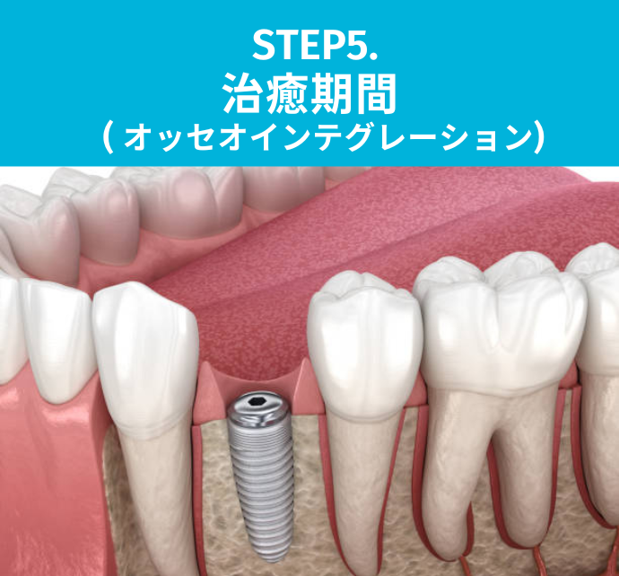 STEP5:治癒期間（オッセオインテグレーション）