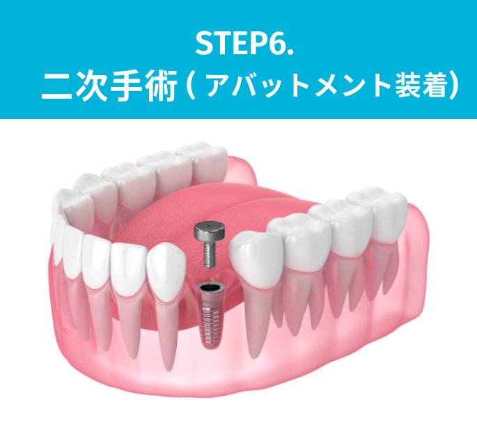 STEP6:二次手術（アバットメント装着）