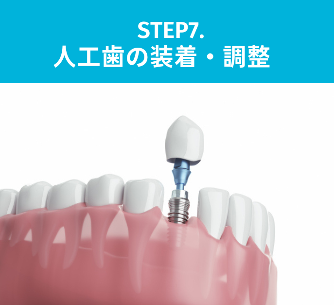 STEP7:人工歯の装着・調整
