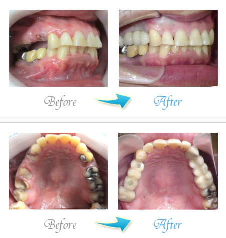 ザ・ホワイトデンタルクリニックのインプラントブリッジの症例