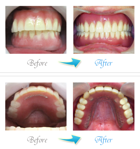 ザ・ホワイトデンタルクリニックのインプラントオーバーデンチャーの症例写真