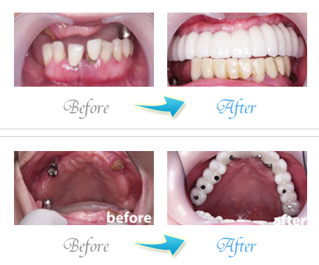 ザ・ホワイトデンタルクリニックのインプラントとセラミッククラウンの症例写真
