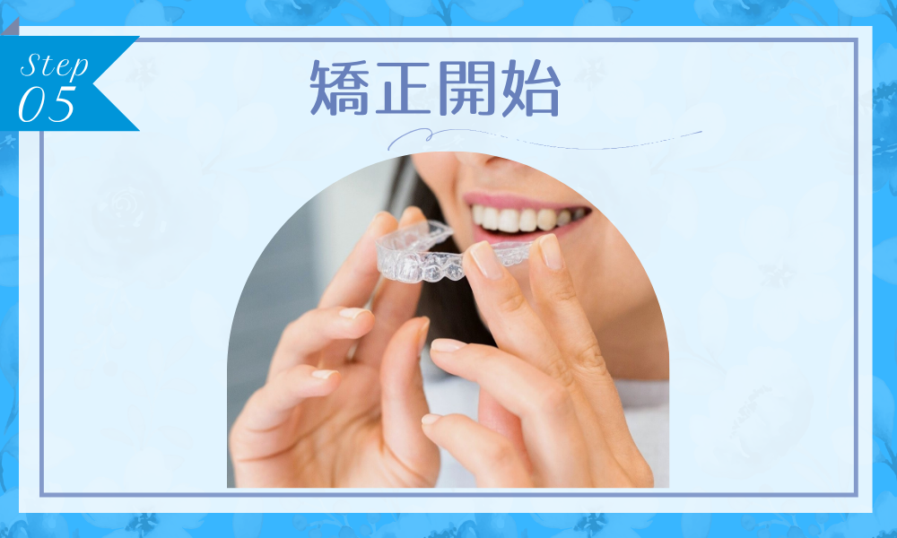 ウィスマイル　ステップ5：矯正開始