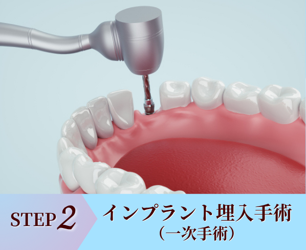 STEP2.インプラント埋入手術