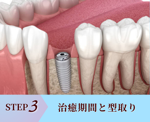STEP3.治癒期間と型取り（スキャン）