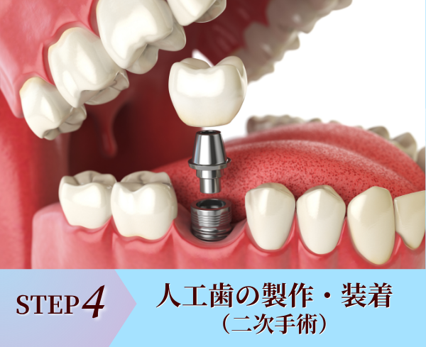 STEP4.人工歯（セラミッククラウン）の製作・装着