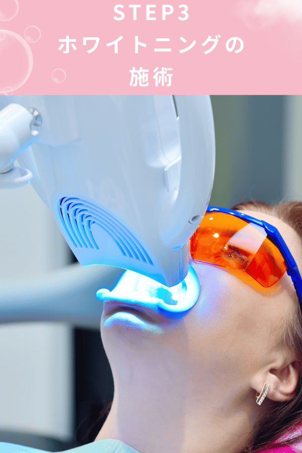 ステップ3：ホワイトニングの施術