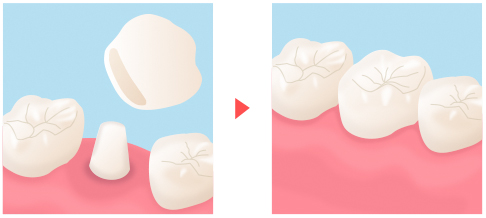 オールセラミック法