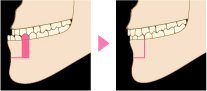 下顎骨切り治療