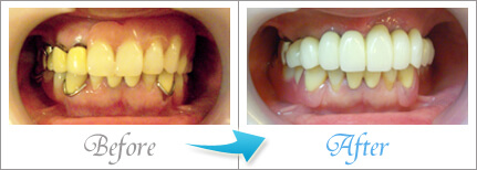 falseteeth