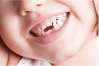 後天的な原因 乳歯の早期喪失