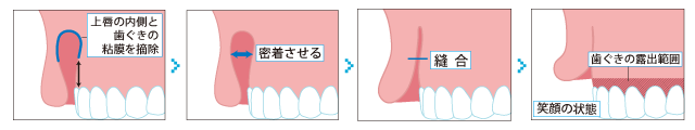 粘膜切除術