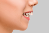 出っ歯がひどい場合の影響 特有の顔つきになる